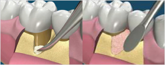 잇몸뼈 이식으로 치아살리기