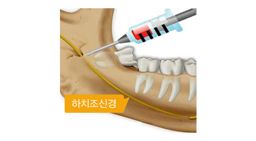 하악신경 전달마취를 하는 모습