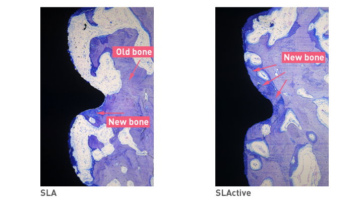 SLA VS SLActive Bone(SLA 대 SLActive의 뼈 형성 모양)