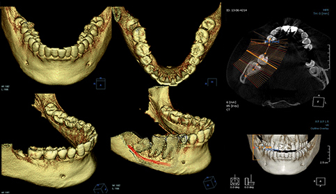 3차원 CT