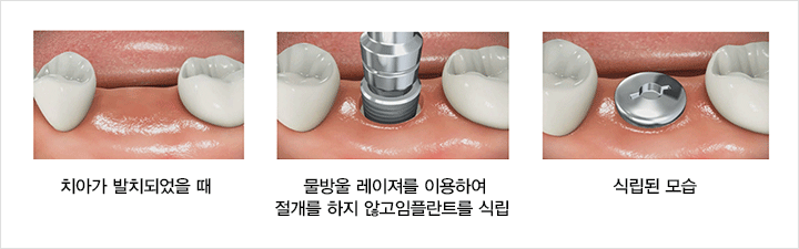 1 치아가 발치되었을 때 2 물방울 레이져를 이용하여 절개를 하지 않고 임플란트를 식립 3 식립된 모습
